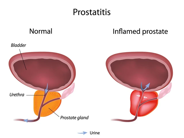 The Role of Alfuzosin in Managing Chronic Prostatitis