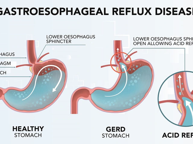 Gastroesophageal Reflux Disease and Functional Dyspepsia: The Overlap Between These Digestive Disorders